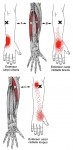 CƠ DUỖI CỔ TAY QUAY DÀI (Extensor Carpi Radialis Longus)