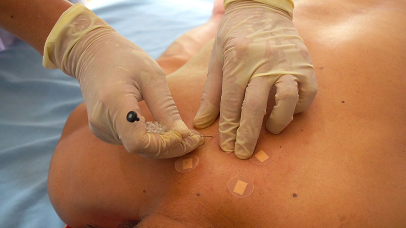 20230321 Cay chi chua thoat vi dia dem duoc phat trien tu phuong phap cham cuu